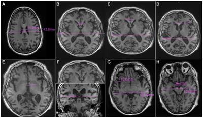 Linear brain measurement: a new screening method for cognitive impairment in elderly patients with cerebral small vessel disease